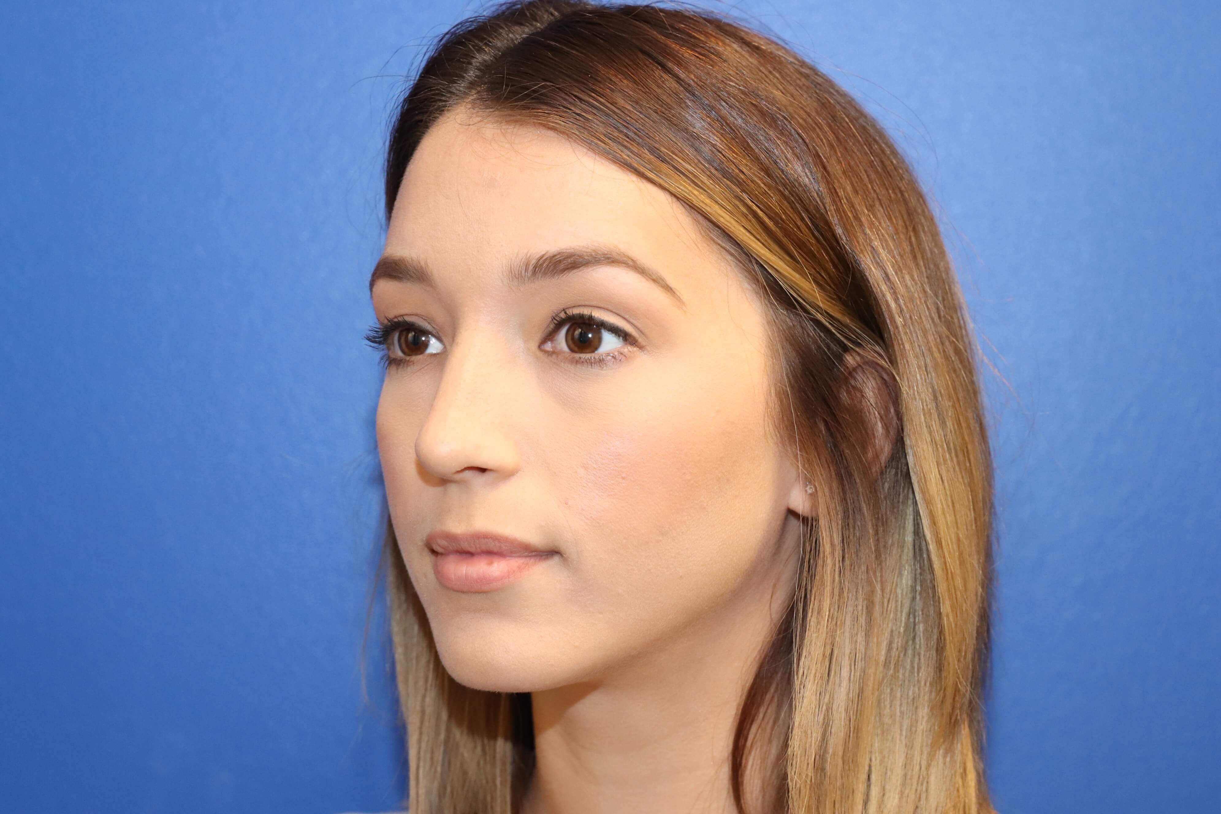 Lower Eyelid Surgery After