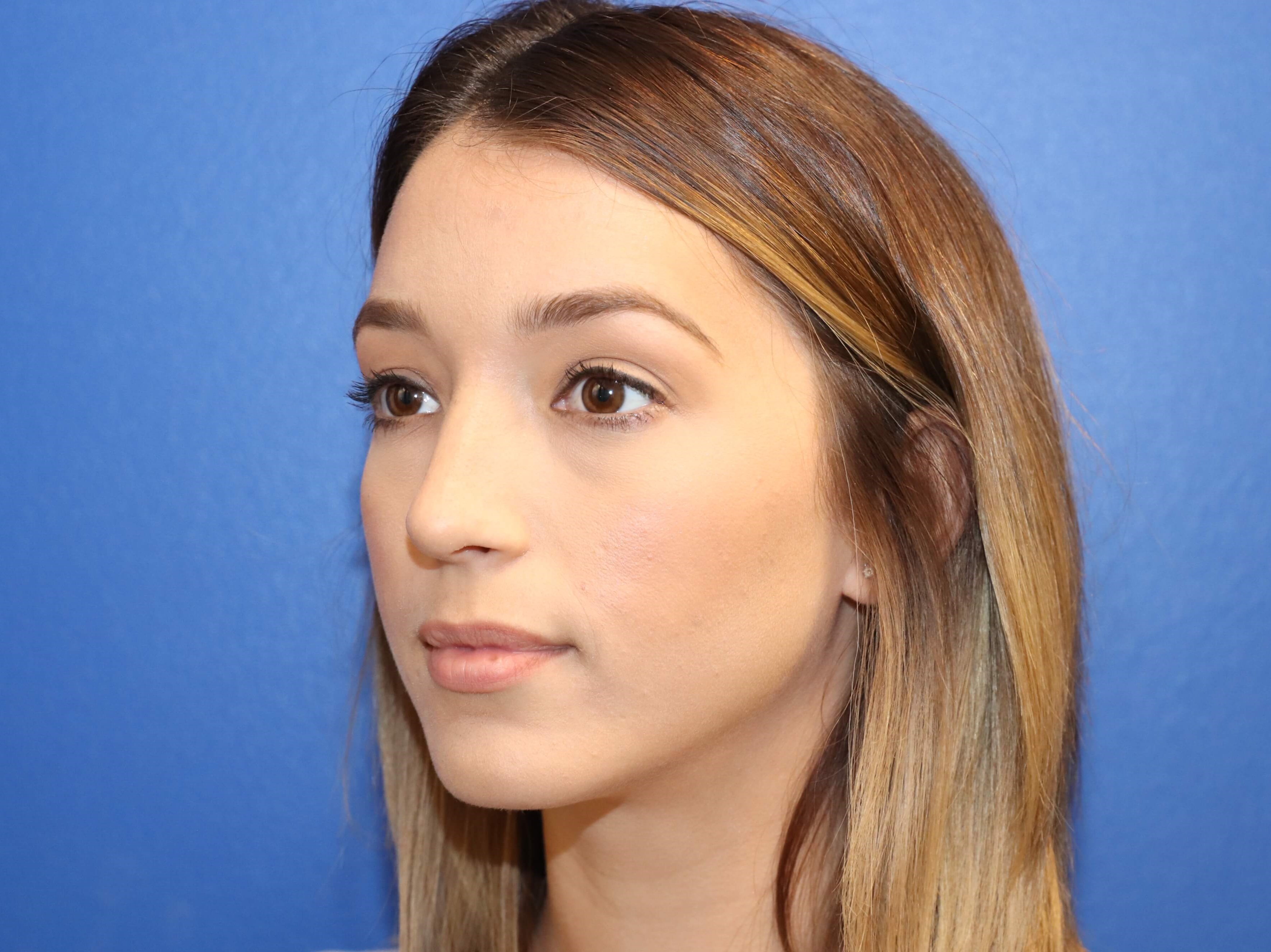 Lower Eyelid Surgery After