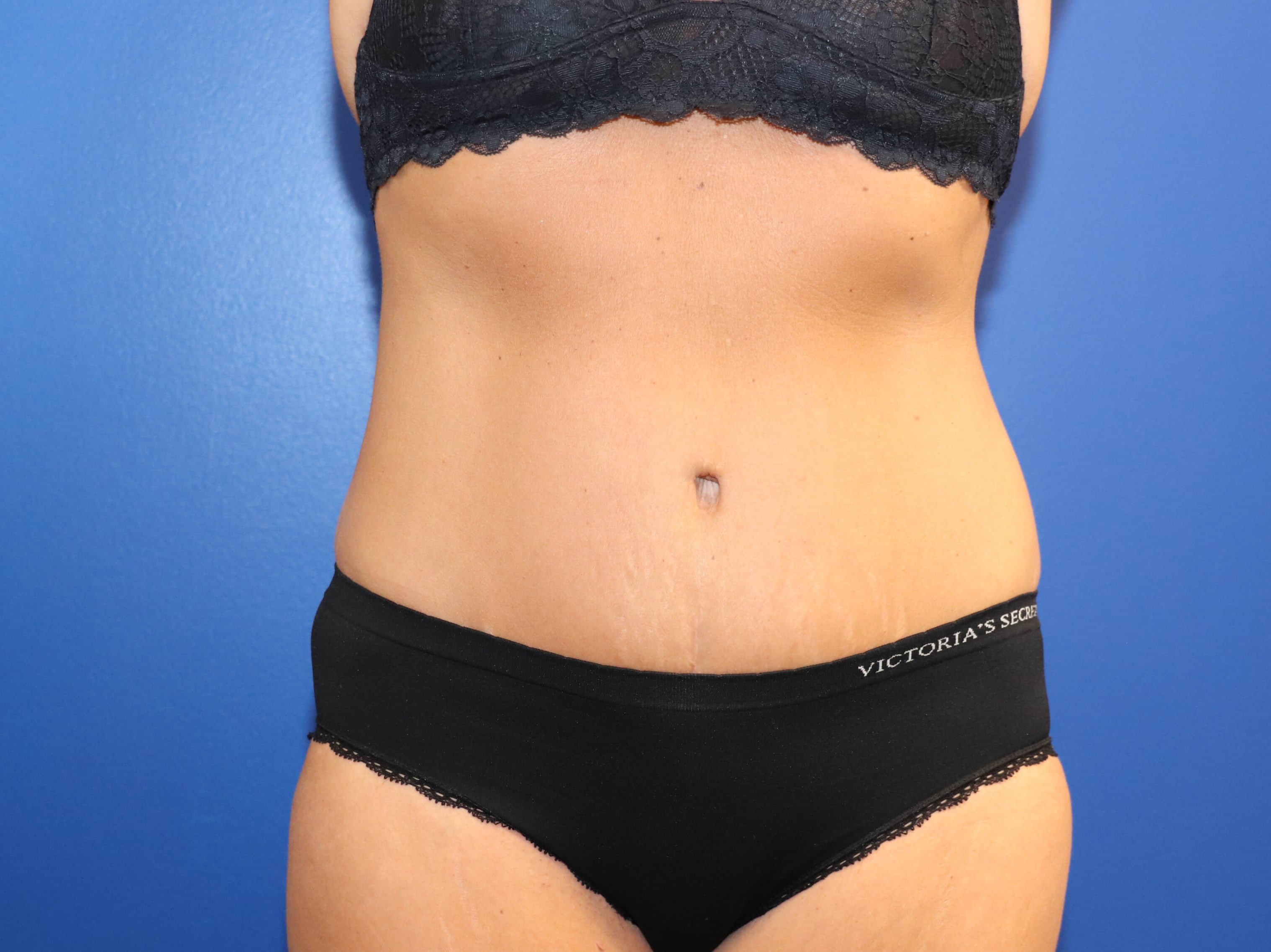 Tummy Tuck After