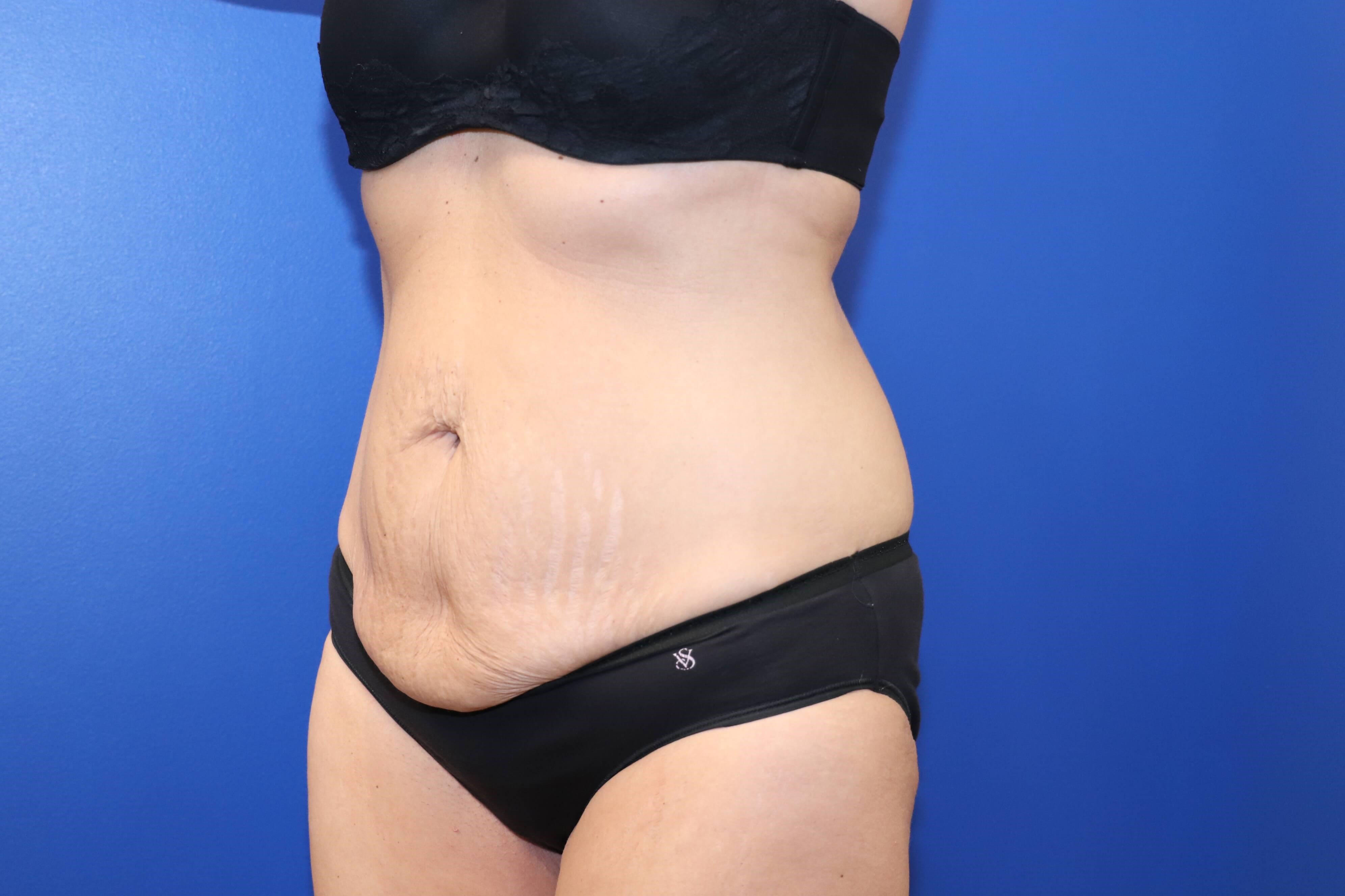 Tummy Tuck Before