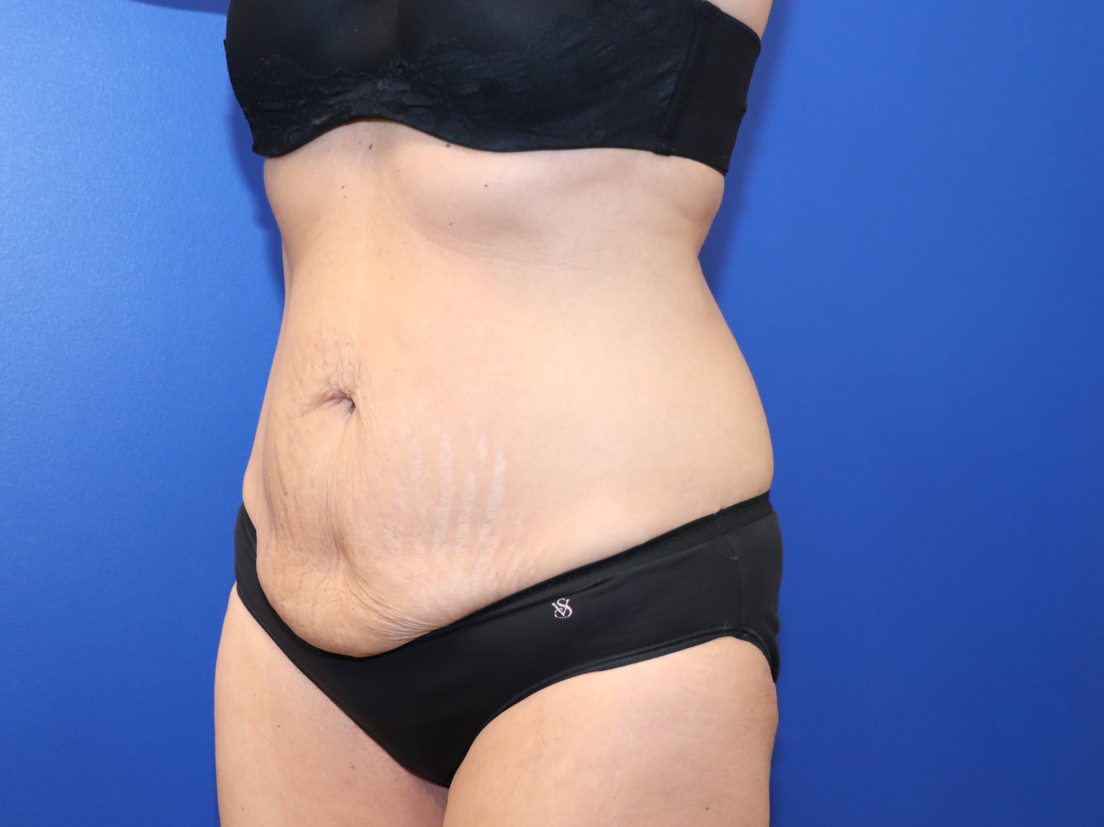 Tummy Tuck Before