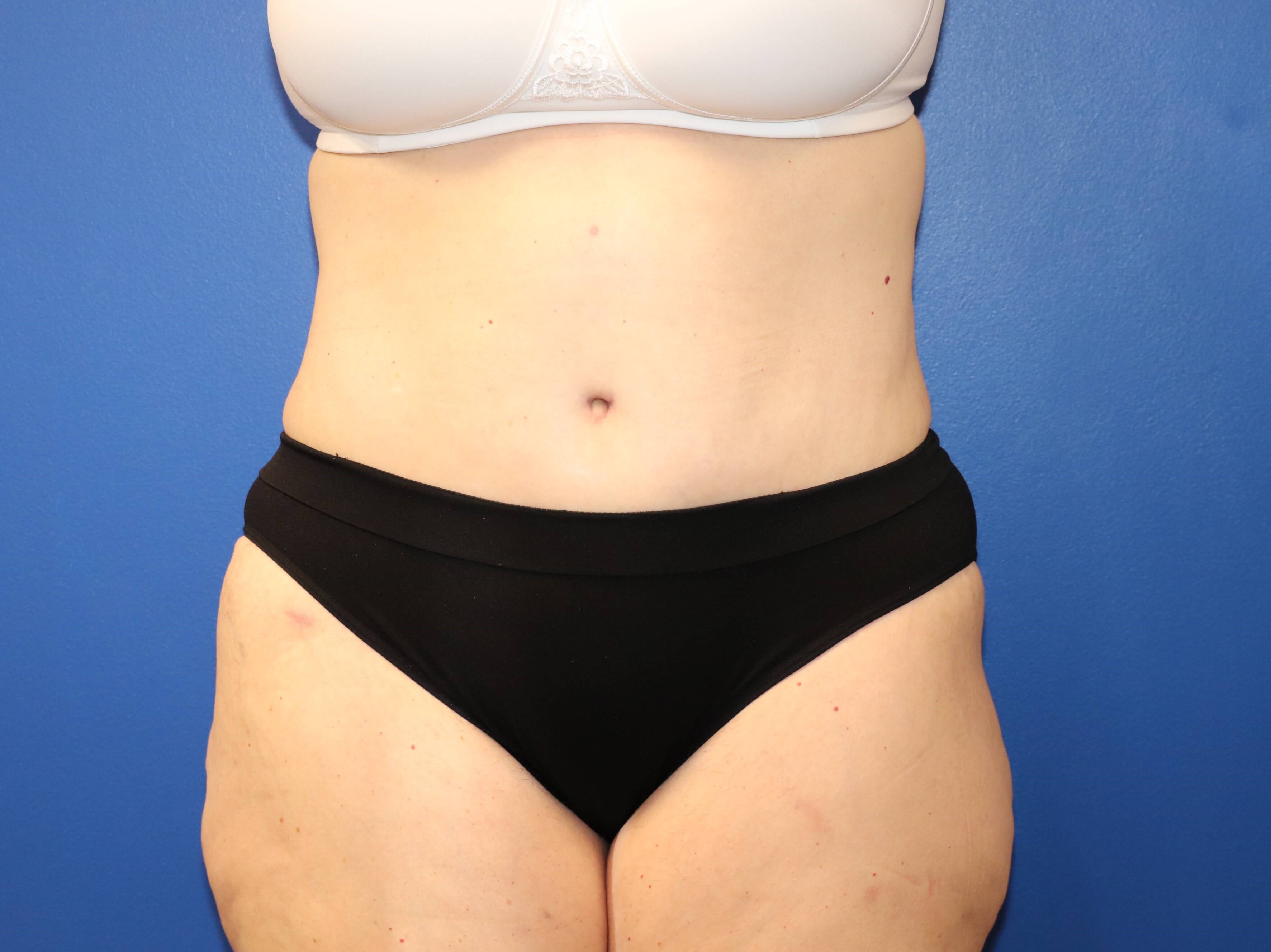 56 year old tummy tuck patient After