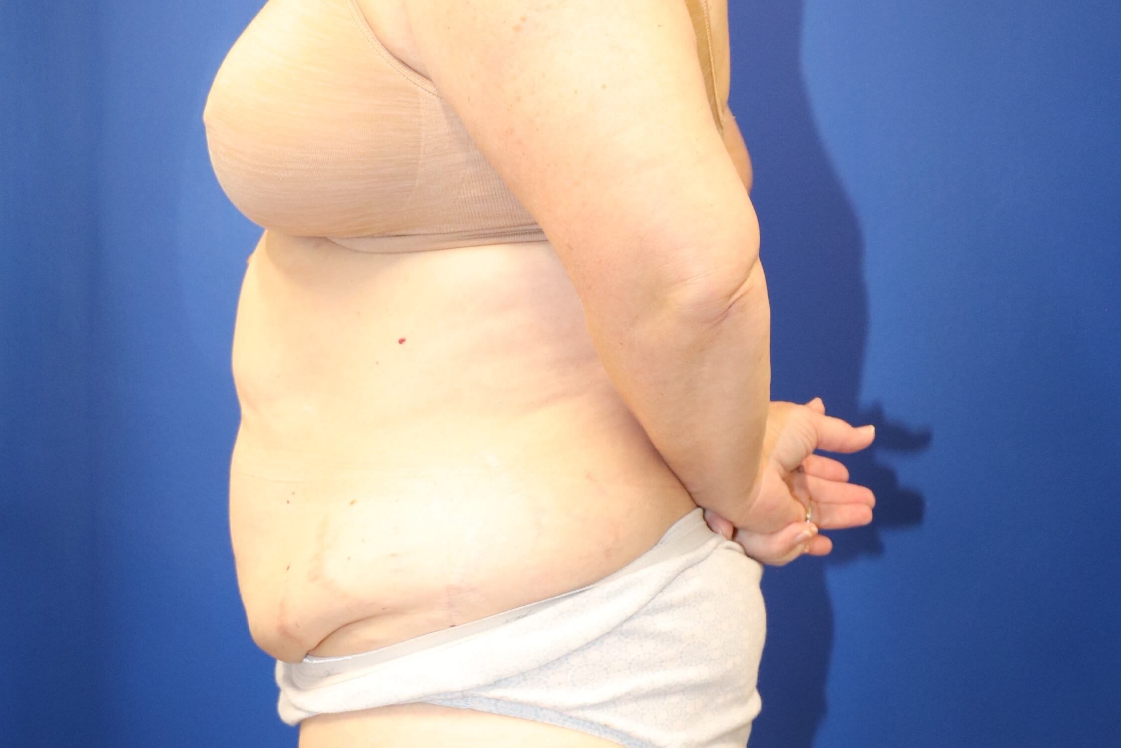 56 year old tummy tuck patient Before