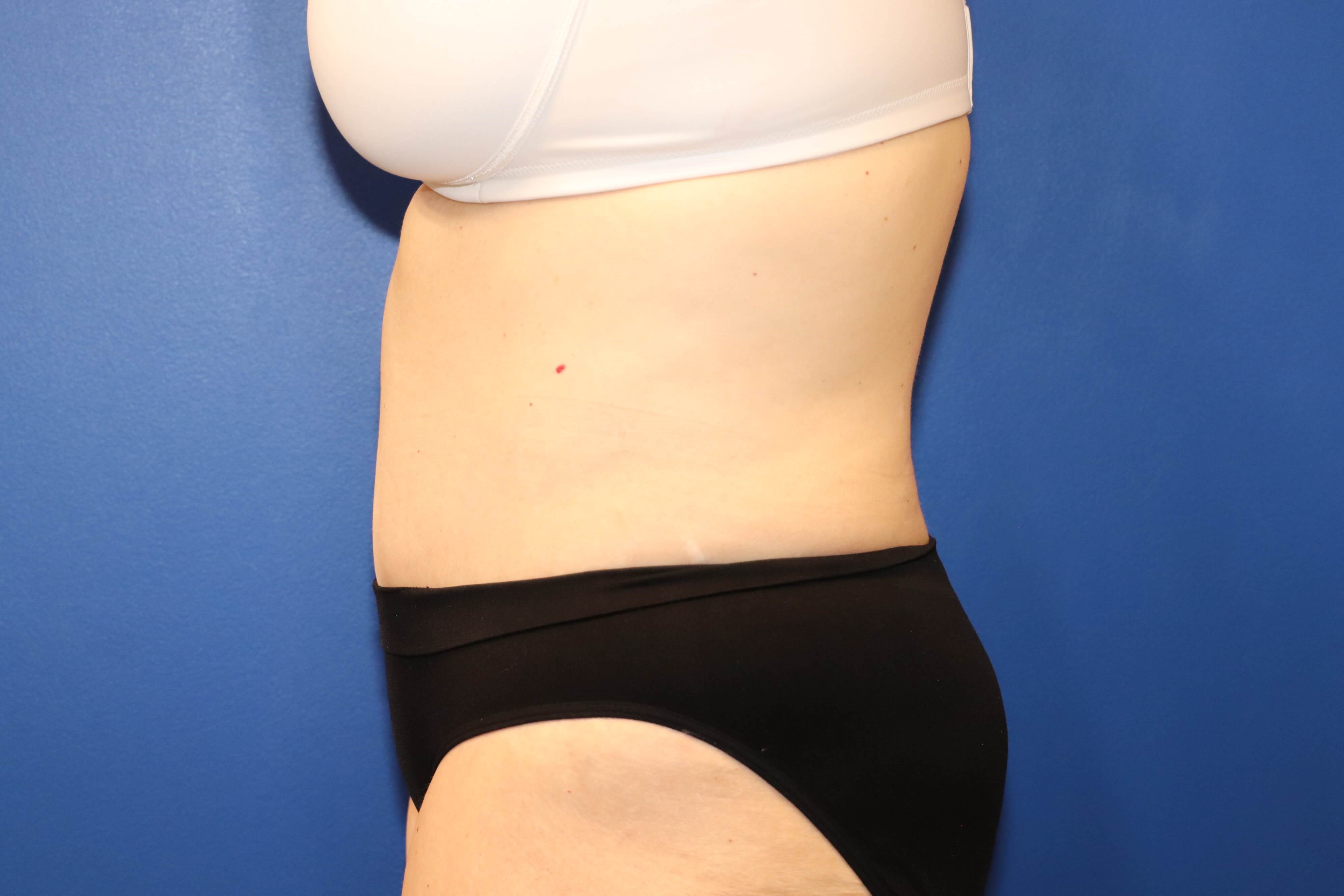 56 year old tummy tuck patient After