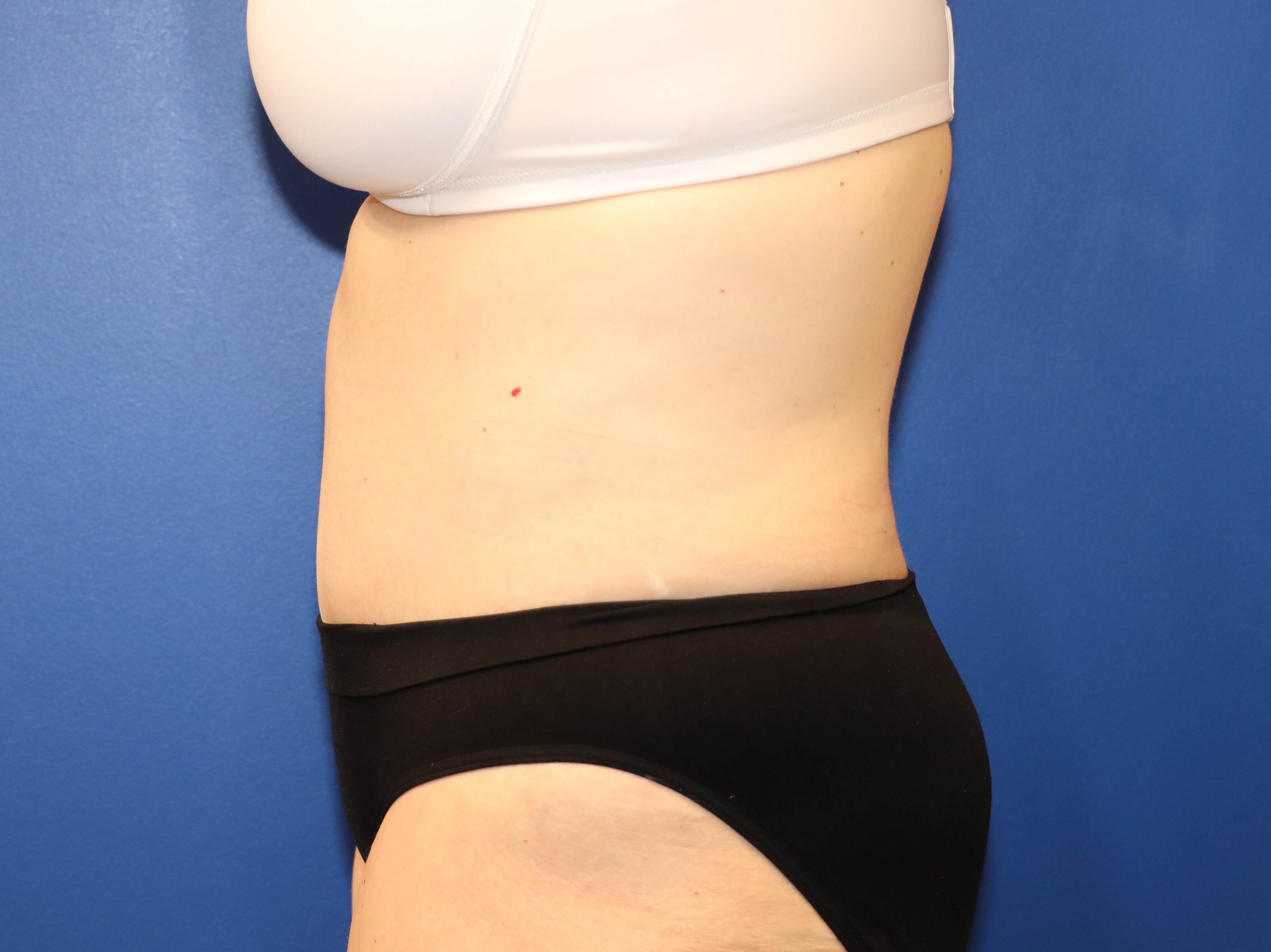 56 year old tummy tuck patient After